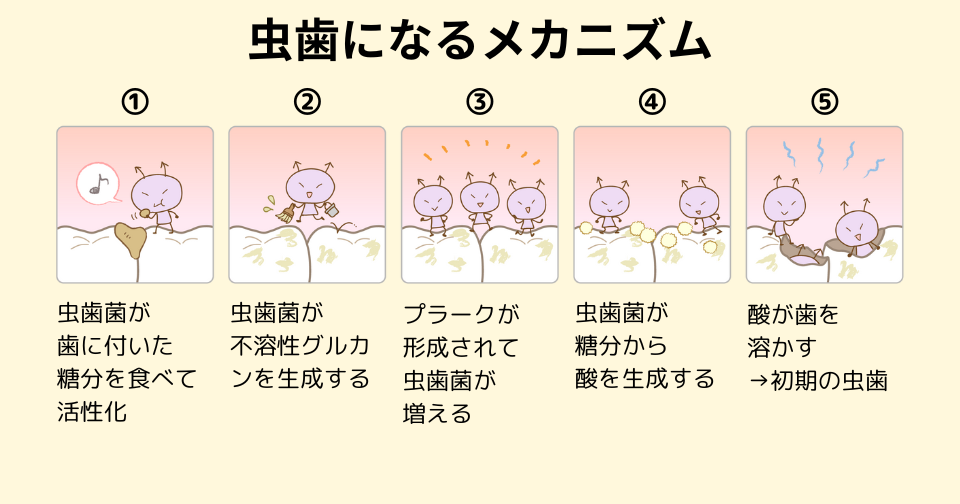 虫歯が発生するプロセス