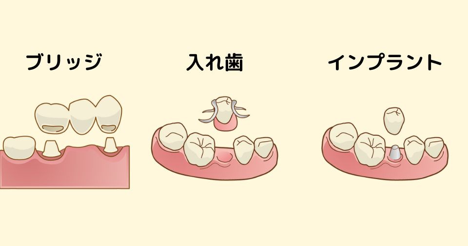 ブリッジ・入れ歯・インプラントの特徴