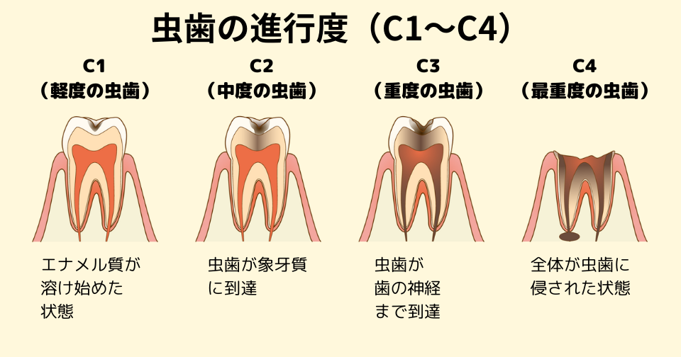 虫歯の進行度